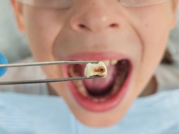 Best Broken or Cracked Tooth Emergency Dentist in Sherrill, NY